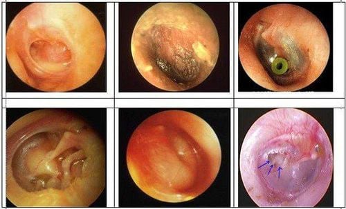 
Chảy dịch ở tai trong viêm tai giữa
