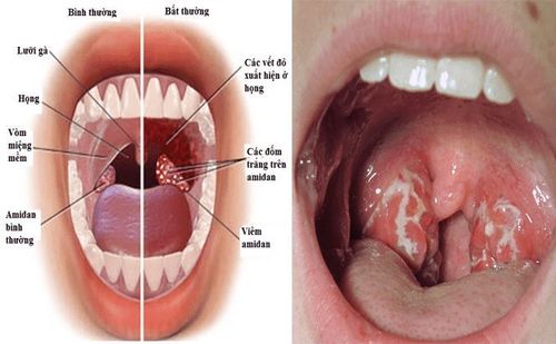 7. Tầm quan trọng của điều trị viêm VA kịp thời