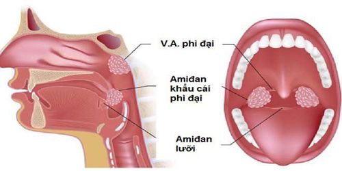 
Nếu vi khuẩn xâm nhập ồ ạt, quá mức có thể gây tình trạng viêm amidan
