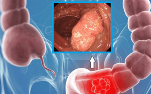 Overview of colorectal polyps