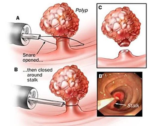 
Cắt bỏ polyp trực tràng bằng nội soi
