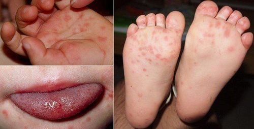 How long does hand, foot and mouth disease in children go away?