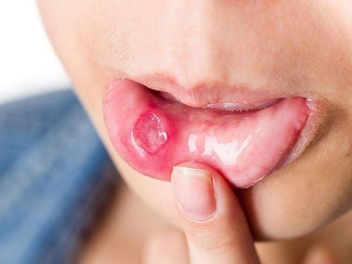 Canker sores (mouth sores) in young children are dangerous?