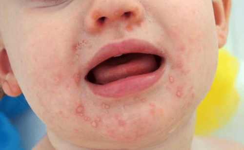 The reason why hand, foot and mouth disease can happen again and again