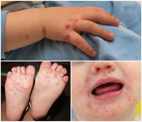 Blisters are a sign of  HFMD in children