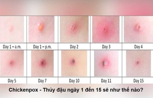 
Hình ảnh nốt mụn nước thủy đậu qua từng ngày
