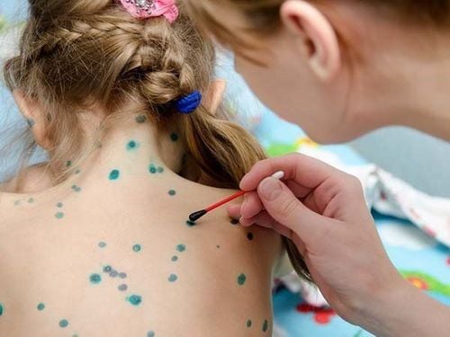 Chickenpox: Causes, symptoms, complications and treatment