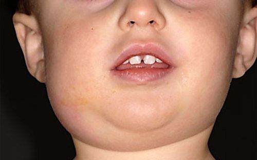 Mumps: Causes, symptoms, complications and prevention