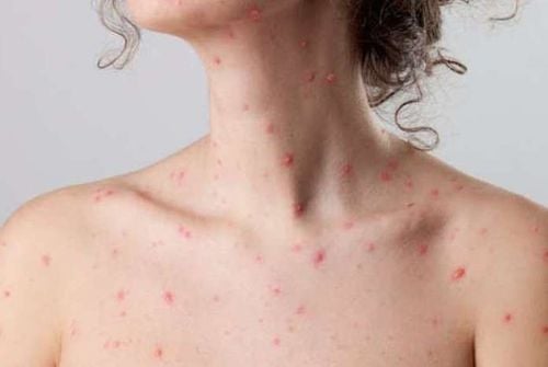 How is chickenpox transmitted?