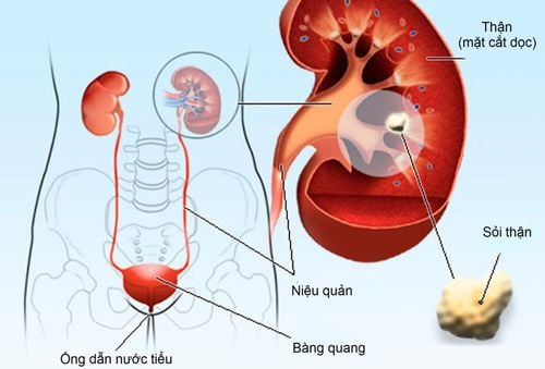 What are the types of kidney stones and which are the most common?