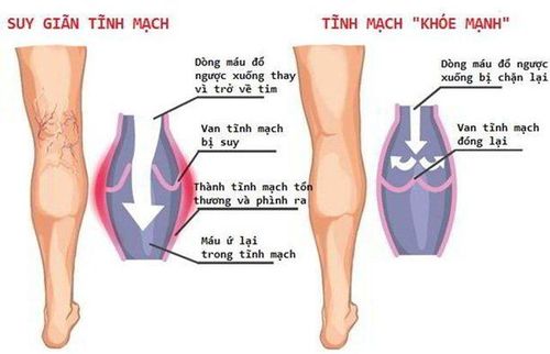 
Điều trị hợp lý bệnh giãn tĩnh mạch sẽ giúp cải thiện chất lượng cuộc sống
