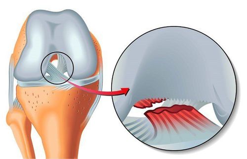 
Bệnh nhân có tiền sử chấn thương dây chằng gối được chỉ định phẫu thuật
