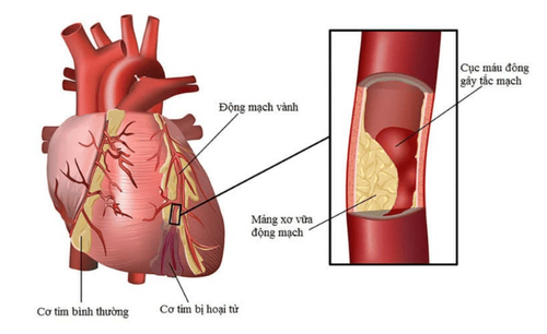 
Đau tức ngực do tắc nghẽn động mạch vành
