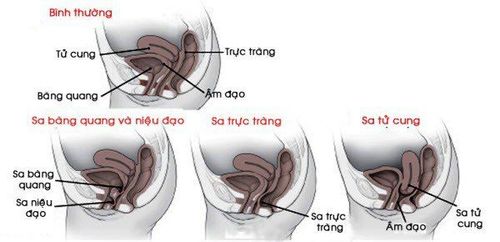 
Hình ảnh sa sinh dục ở phụ nữ.
