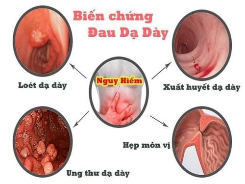 
Viêm loét dạ dày có thể gây ra nhiều biến chứng nguy hiểm
