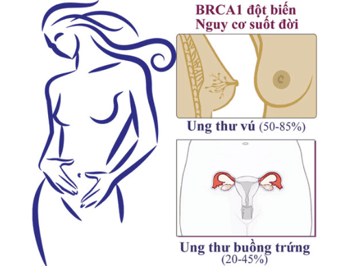 
Những phụ nữ có đột biến gen BRCA1 và BRCA2 có thể có đến 80% nguy cơ mắc ung thư vú
