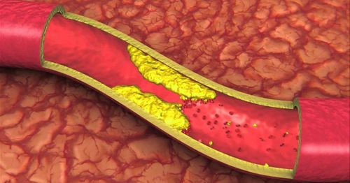 Learn about blood lipid tests