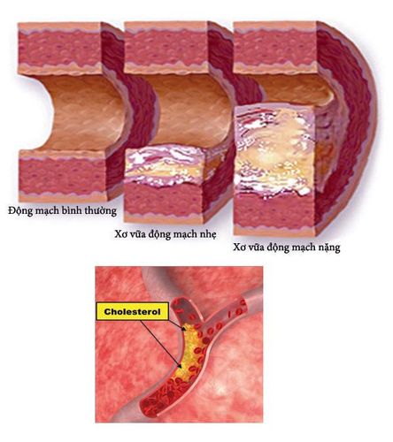 High blood fat: two decrease three increase