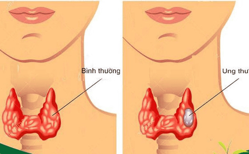 
Làm thế nào để phát hiện ung thư tuyến giáp?
