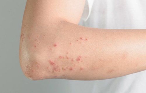 Is it dangerous for people with chronic hepatitis B to appear hot and itchy?