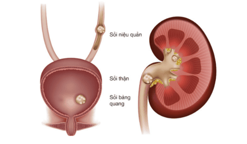 
Sỏi có thể ở bất kì vị trí nào trên đường niệu
