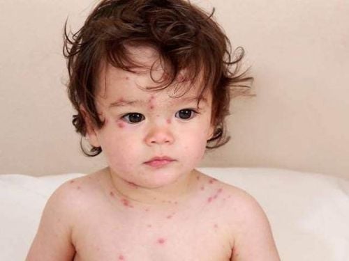 Trẻ 6 tháng tuổi bị thủy đậu bôi thuốc gì?