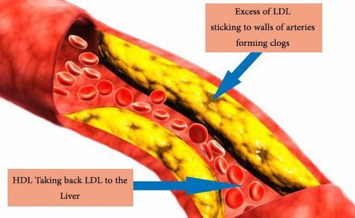 
LDL cholesterol gây vữa xơ động mạch
