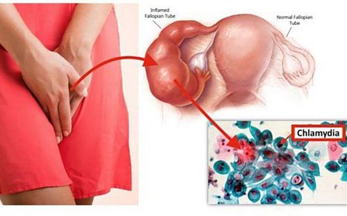 What is Genital Chlamydia? Causes, symptoms, ways to prevent