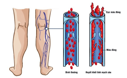 
Sự hình thành cục máu đông trong tĩnh mạch
