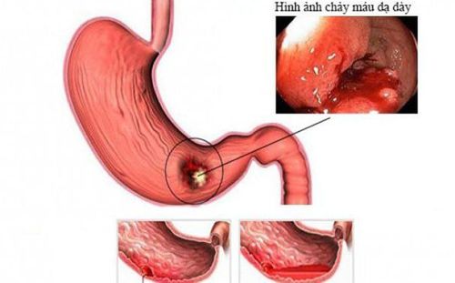 
Phác đồ truyền máu khối lượng lớn có thể được sử dụng trong chảy máu đường tiêu hoá
