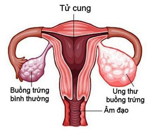 4 giai đoạn của ung thư buồng trứng