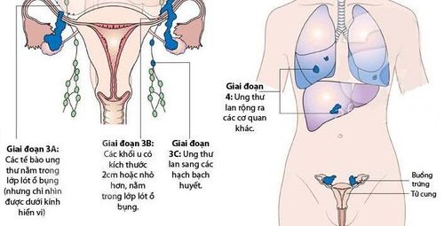 
Ung thư buồng trứng giai đoạn 3 và 4
