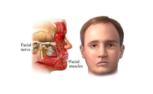 Anesthesia mask larynx endoscopic surgery decompresses nerve to treat facial paralysis