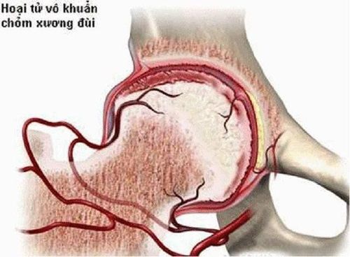 
Hình ảnh hoại tử vô khuẩn chỏm xương đùi
