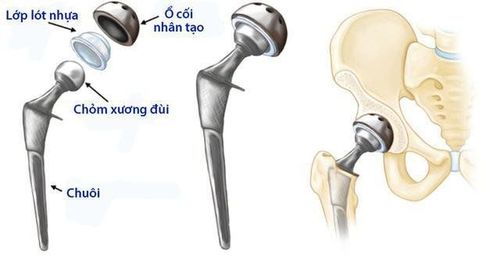 
Phương pháp thay khớp háng
