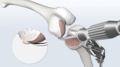 Complete knee replacement procedure