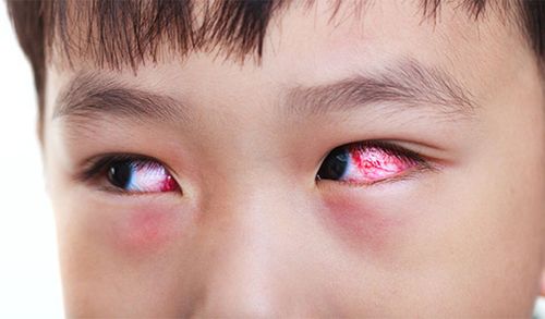 How is conjunctivitis transmitted? What to avoid when sick?