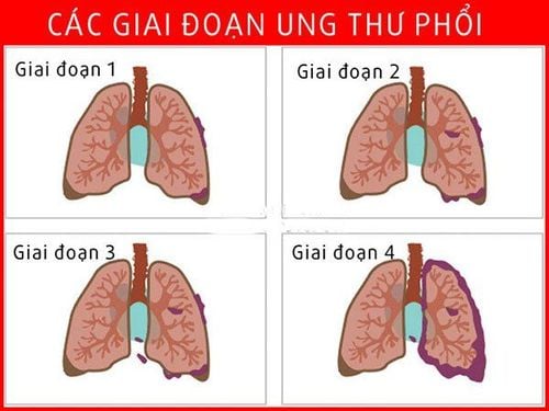 
Ung thư phổi có 4 giai đoạn
