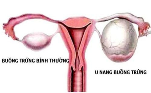 
U buồng trứng có thể dẫn đến dậy thì sớm
