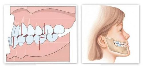 How is malocclusion treated?