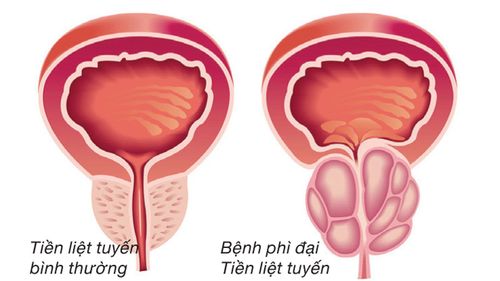 What are the treatments for benign prostatic hypertrophy?