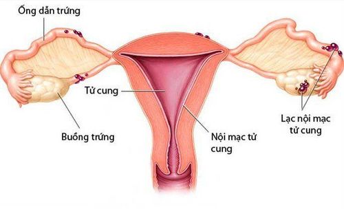 U lạc nội mạc tử cung