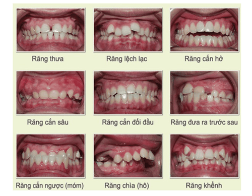 
Các loại sai lệch khớp cắn thường gặp
