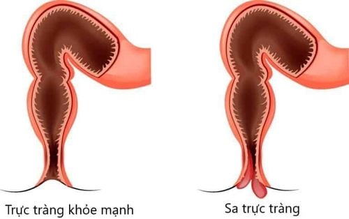 Advantages and disadvantages of laparoscopic surgery for adult rectal prolapse