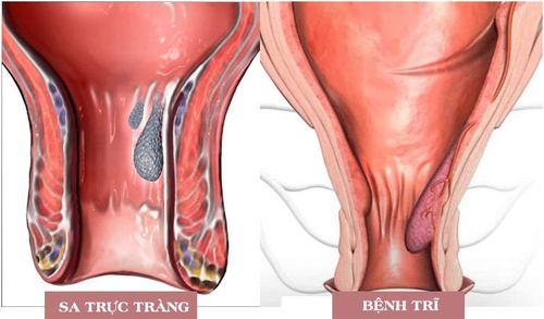 Are rectal prolapse and hemorrhoids the same?