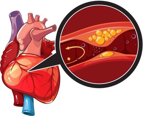 
Nong động mạch vành có chỉ định ở những bệnh nhân có chẩn đoán bệnh cơ tim thiếu máu cục bộ
