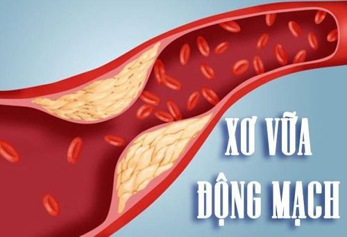 
Nguyên nhân gây thiếu máu cơ tim chủ yếu do xơ vữa
