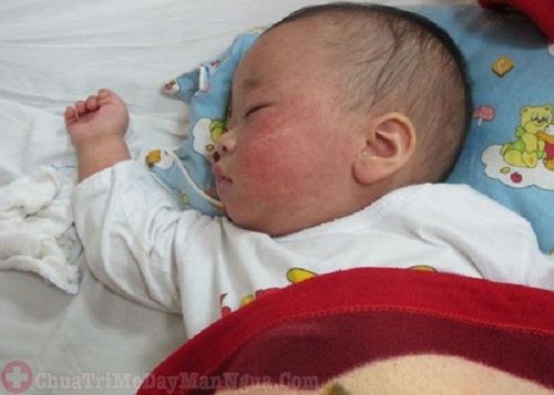 Phát ban thường sẽ xuất hiện sau các cơn sốt