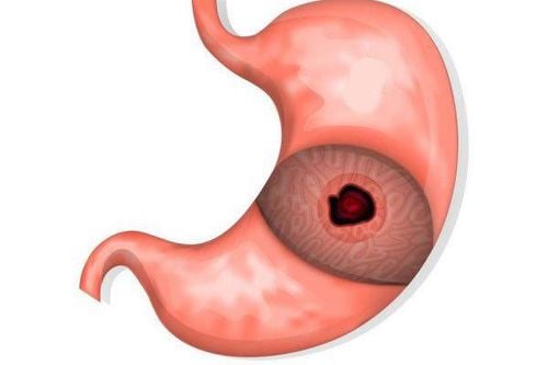 Possibility of perforation of the stomach if severe gastric ulcer is present