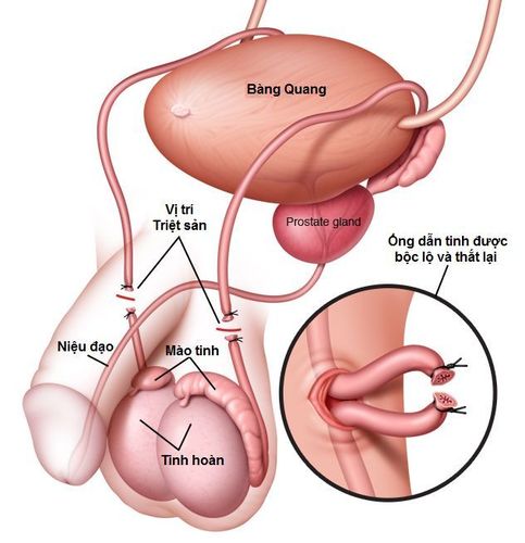 
Thắt ống dẫn tinh giúp ngăn tinh trùng phóng ra
